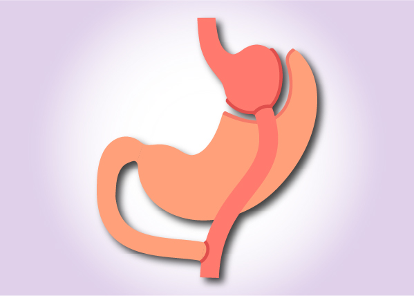 Laparoscopic Roux-EN-Y Gastric Bypass