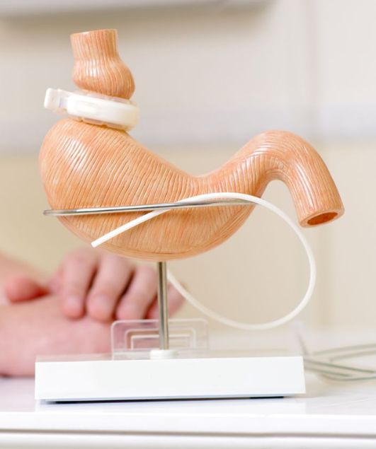 Gastric Band Stomach Model