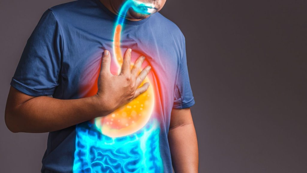 How Gallstones Influence Acid Reflux