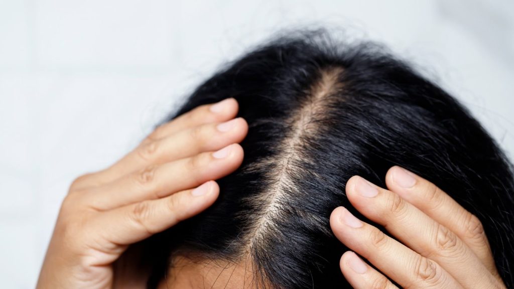 Causes of Hair Loss After Gastric Bypass