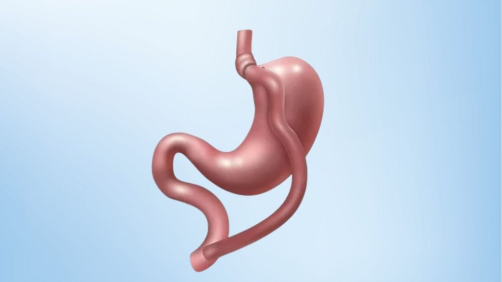 Impact of Gastric Sleeve Surgery on Ghrelin Levels