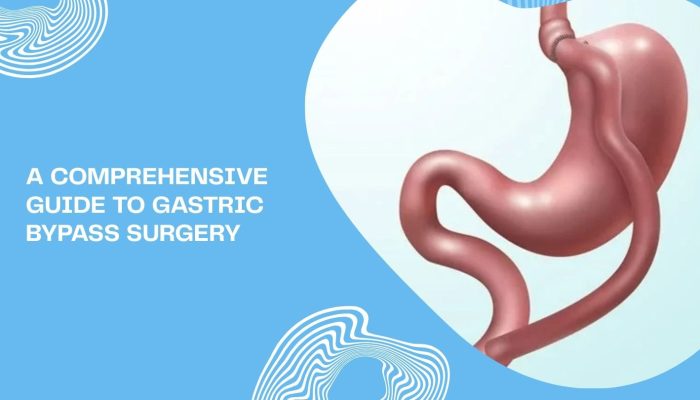 A Comprehensive Guide to Gastric Bypass Surgery