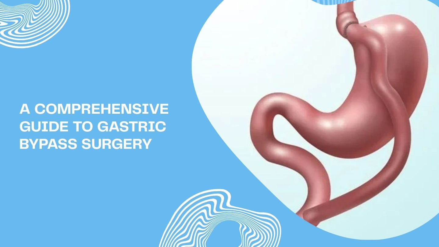 A Comprehensive Guide to Gastric Bypass Surgery