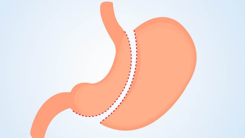 Types of Bariatric Surgery Procedures