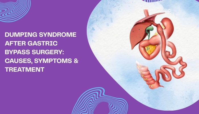 Dumping Syndrome After Gastric Bypass Surgery: Causes, Symptoms & Treatment Dumping Syndrome After Gastric Bypass Surgery: Causes, Symptoms & Treatment