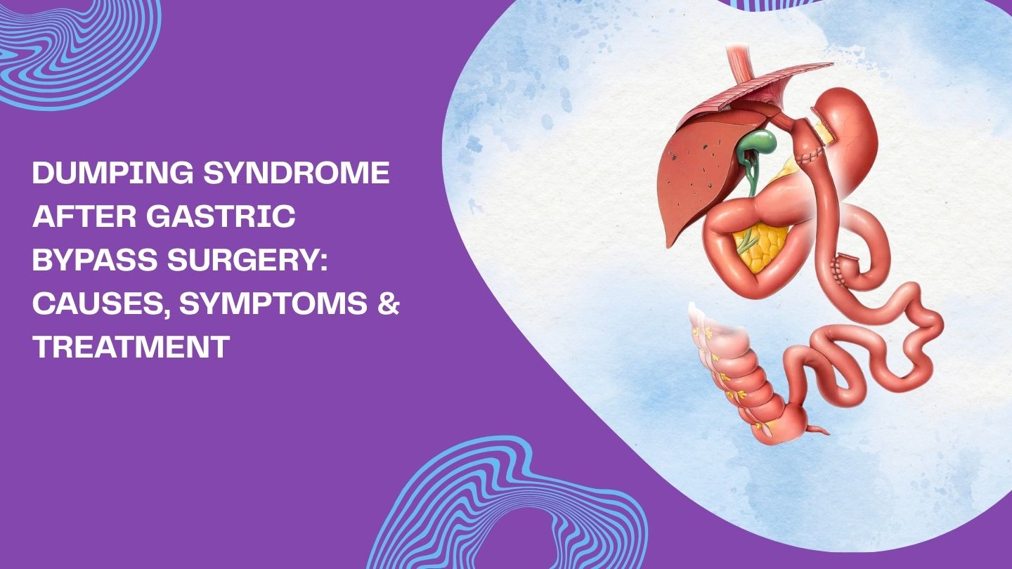 Dumping Syndrome After Gastric Bypass Surgery: Causes, Symptoms & Treatment Dumping Syndrome After Gastric Bypass Surgery: Causes, Symptoms & Treatment