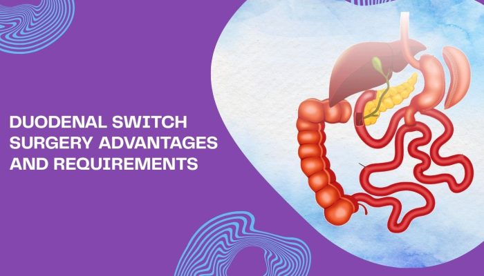Duodenal Switch Surgery Advantages and Requirements Duodenal Switch Surgery Advantages and Requirements