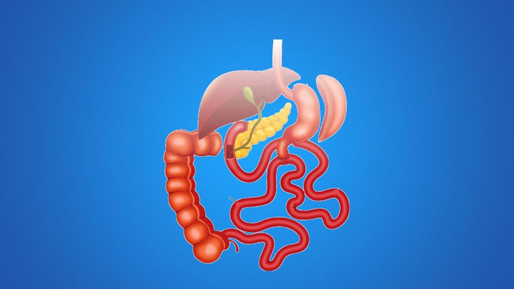 Understanding the Duodenal Switch