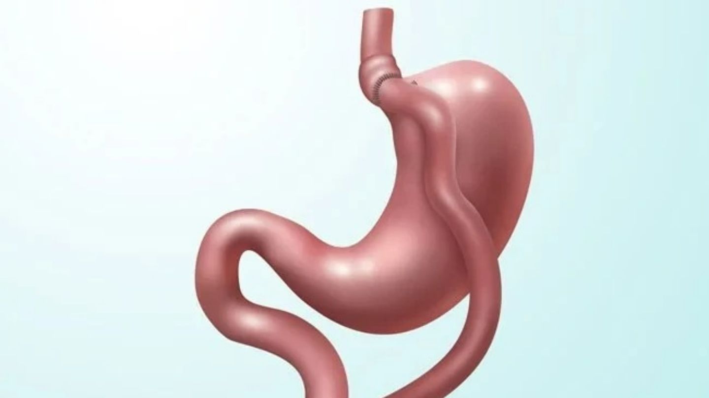 How Sleeve Surgery Alters This System