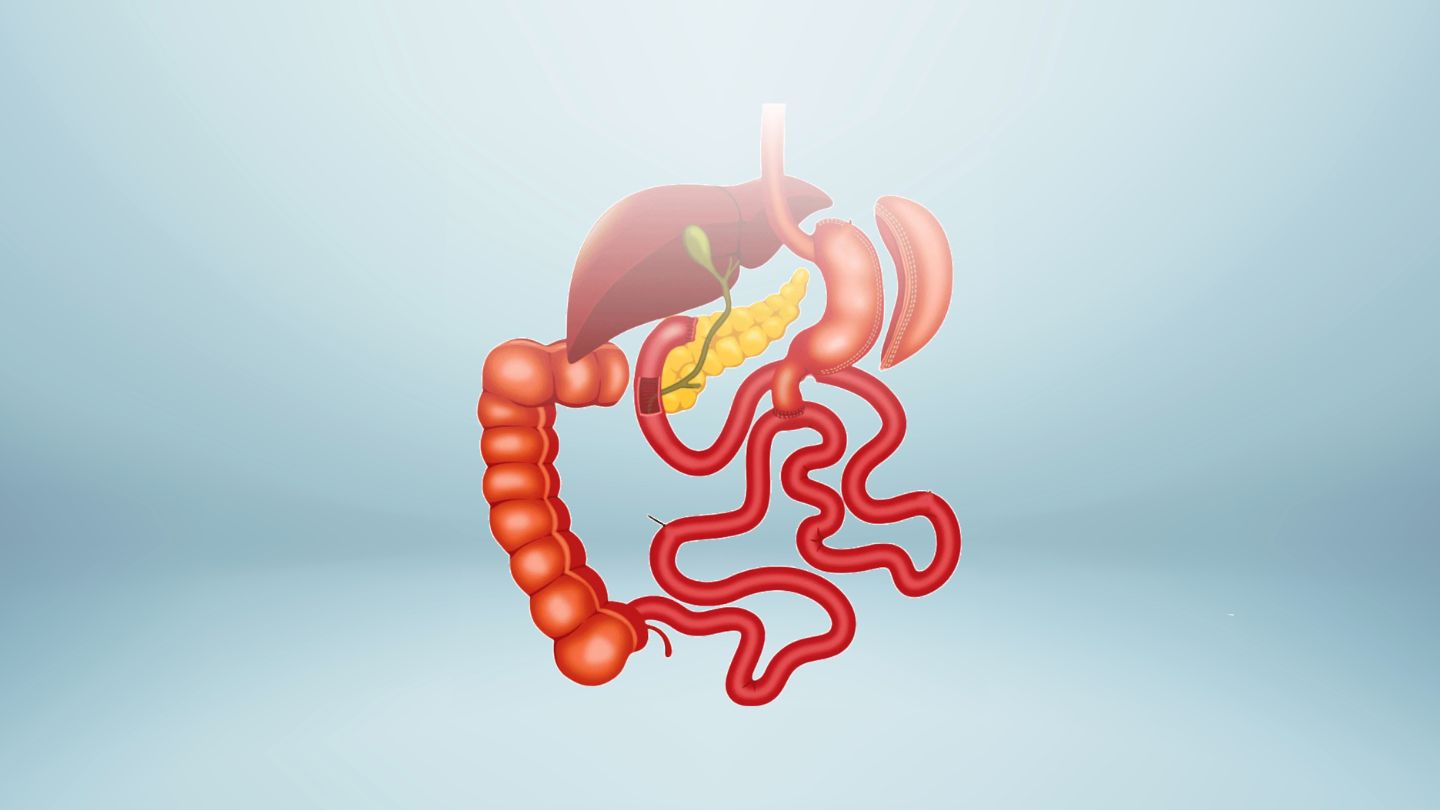 What Is Duodenal Switch Surgery (Biliopancreatic Diversion with Duodenal Switch)?