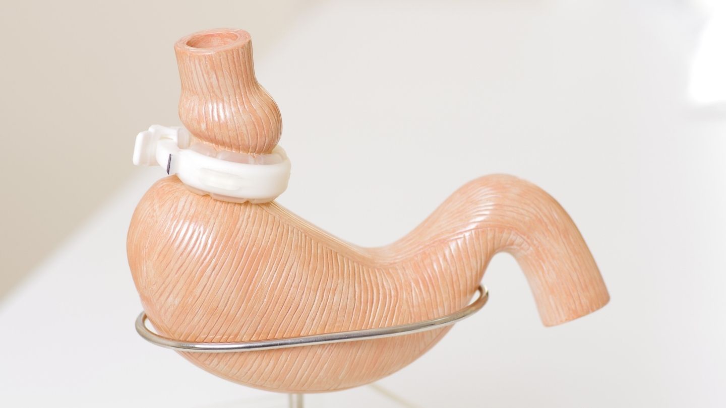 Benefits of Choosing Lap Band Surgery Today