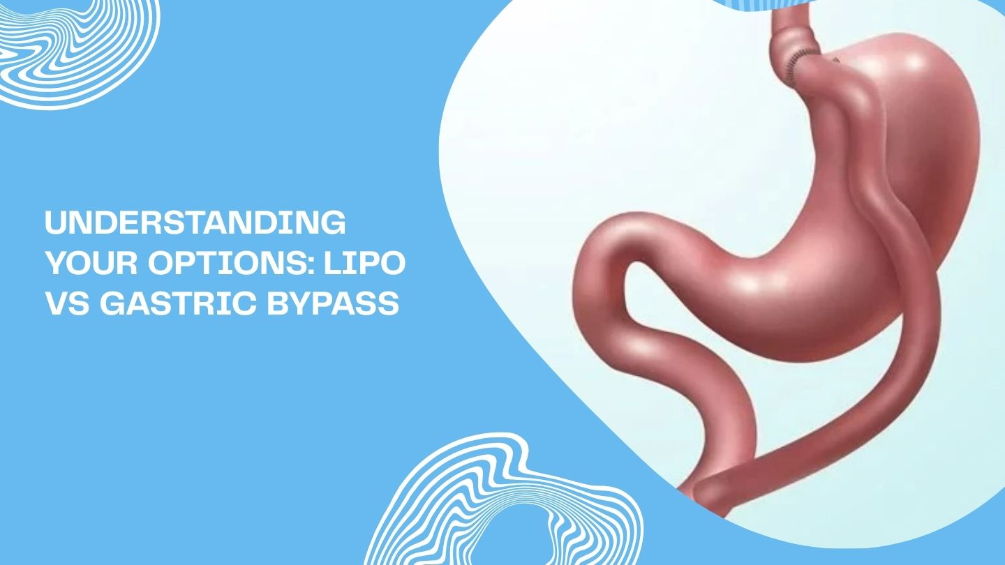 Understanding Your Options: Lipo vs Gastric Bypass
