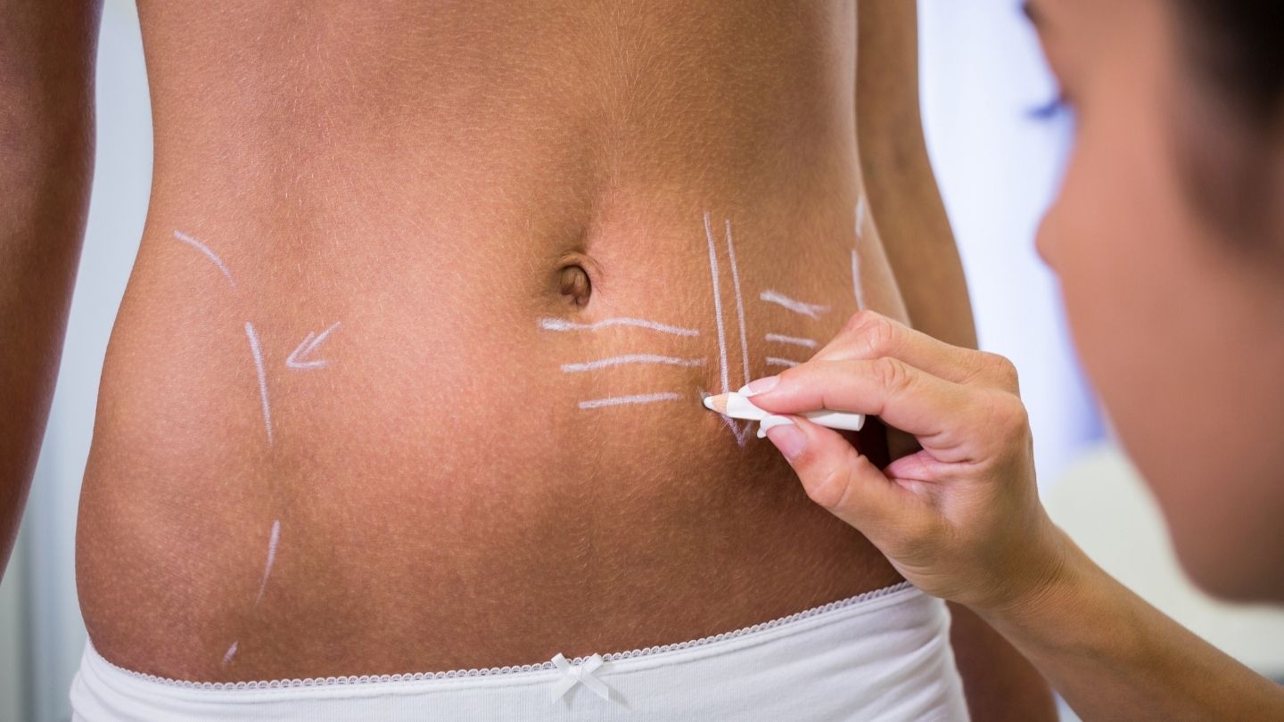 What Is Liposuction? 